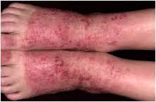 Cara mengatasi eksim pada kaki Cara mengatasi eksim pada kaki