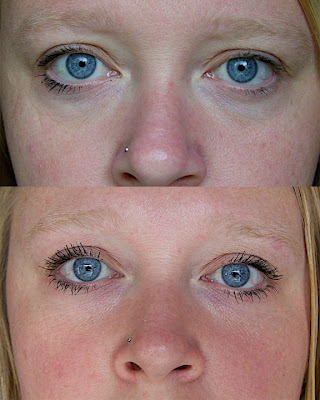 hemorrhoid cream dark circles