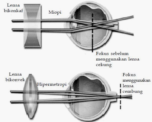miopi dan hipermetropi