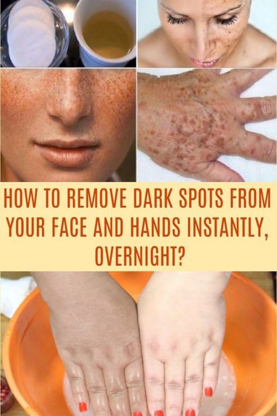 How To Get Rid of Pigmentation And Dark Spots Naturally Food Blog