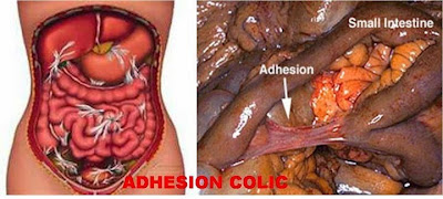 Image result for adhesion colic