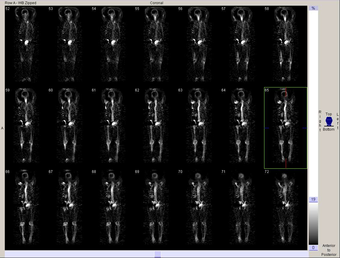 Nuclear Medicine Technology Program: Whole Body Bone SPECT