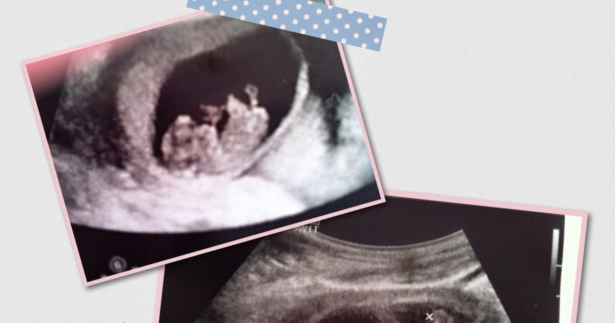 Asherman Syndrom: Wie versprochen