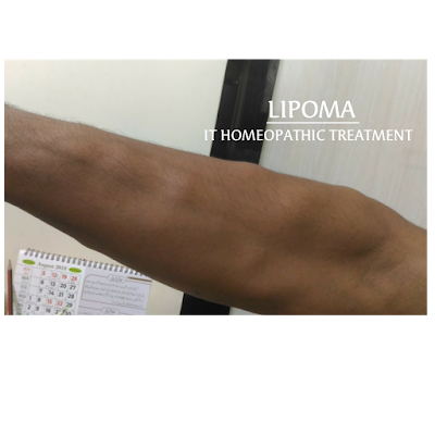 Lipoma And Homeopathy Treatment 
