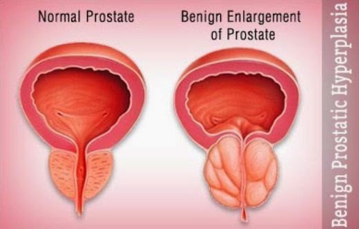 Benign Prostatic Hyperplasia, BPH