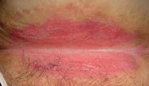 Anal Skin Rash 80