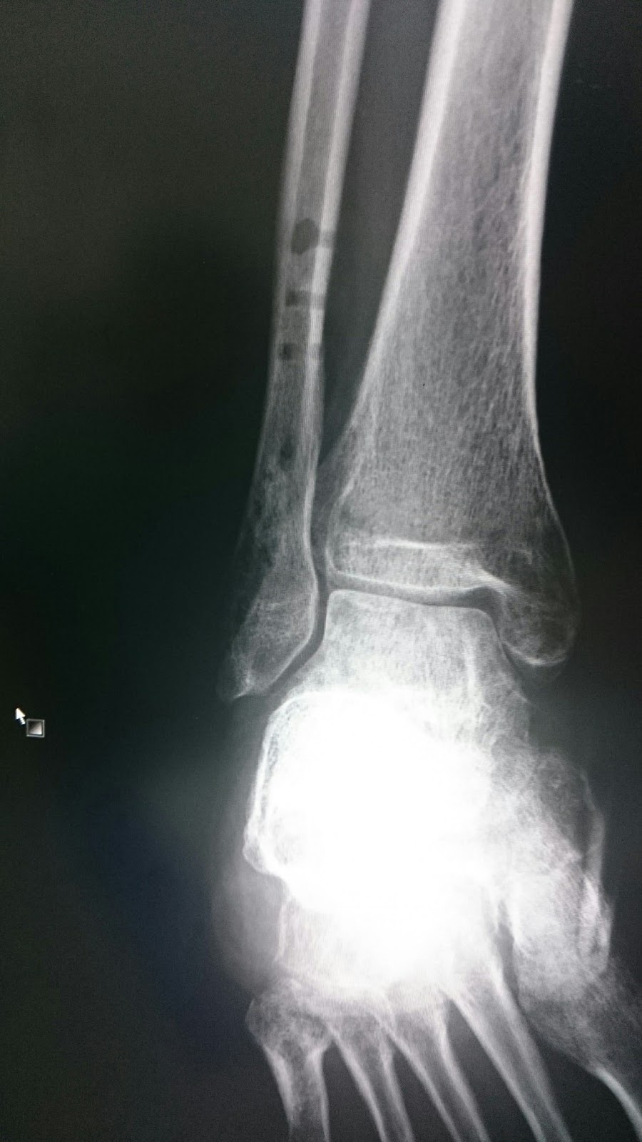 右足間接外果骨折 126日目 再入院86日目 退院決定 入院生活に終止符 好奇心旺盛なアマツ人blog