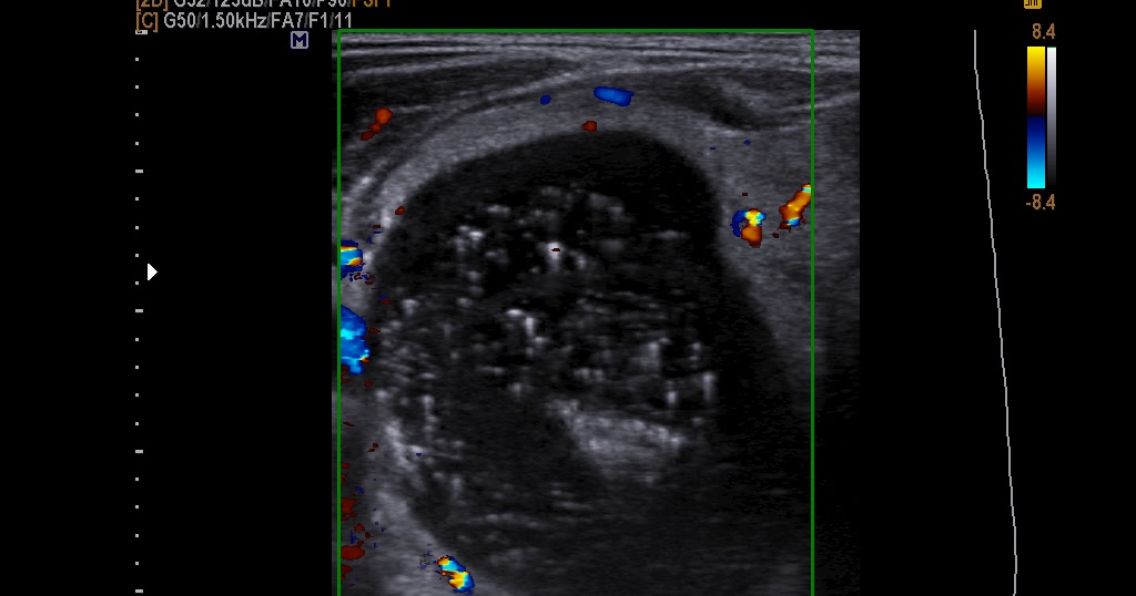 VIETNAMESE MEDIC ULTRASOUND: CASE 157: THYROID CYST with COMET TAIL ...