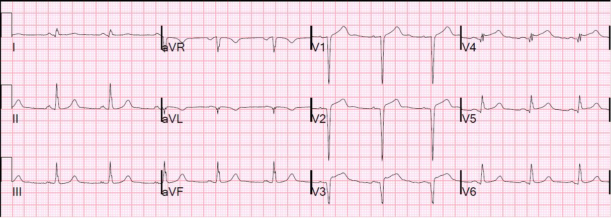 Dr. Smith&#39;s ECG Blog: Prolonged Chest Pain. Is this LV aneurysm or acute anterior STEMI ...