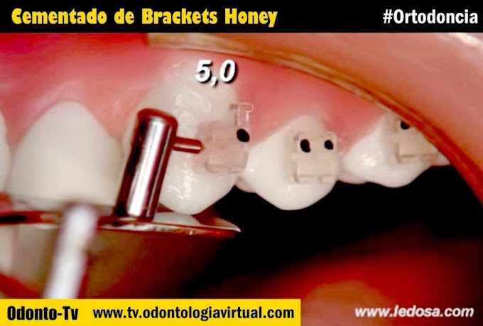 ORTODONCIA: Cementado Brackets Honey
