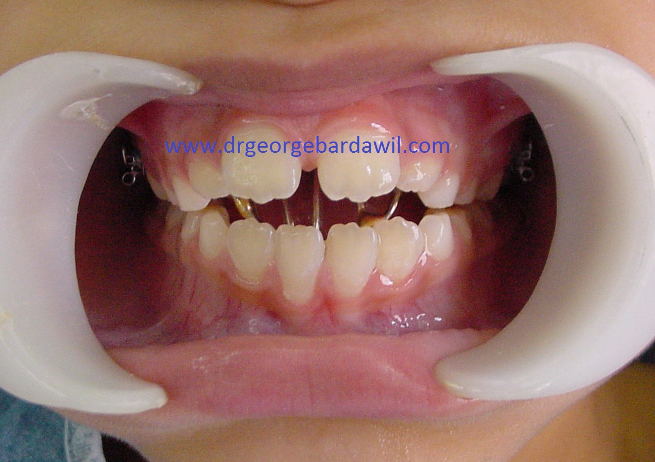E. BardawilOrthodontistInvisalign Diamond level Thumb