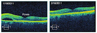 A figure from Intermediate Physics for Medicine and Biology showing an image obtained using optical coherance tomography.