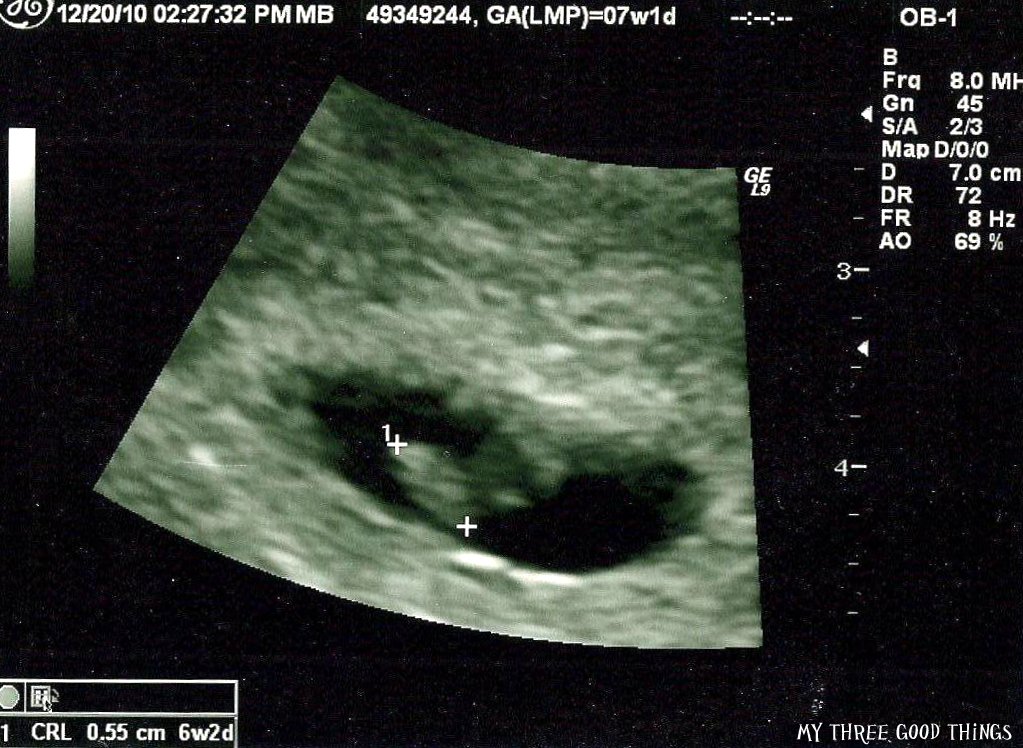 My Three Good Things Coping with Miscarriage