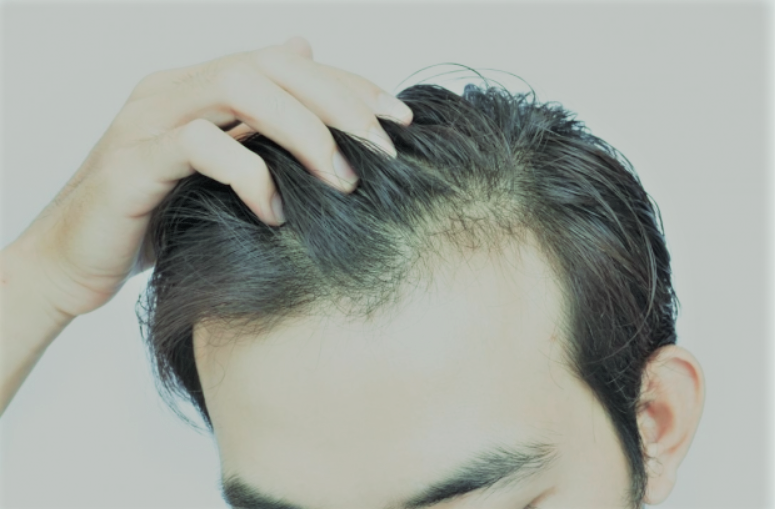How To Stop Hair Fall Immediately Men Best Home Remedies To Stop