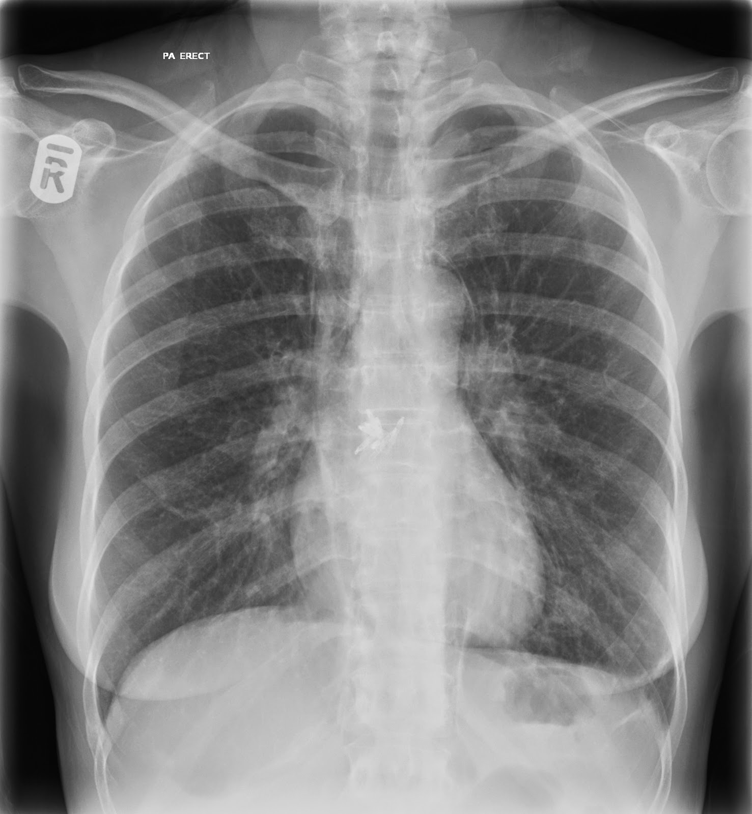 normal chest xray