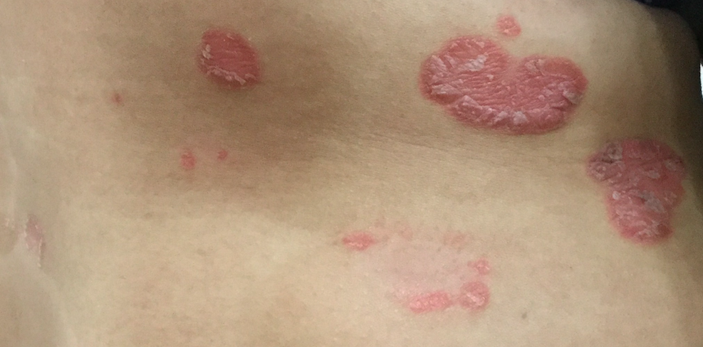 乾癬產後復發 該怎麼辦呢 中醫皮膚 Dr Syuan宣草集中醫診所 邱柏瑄中醫師