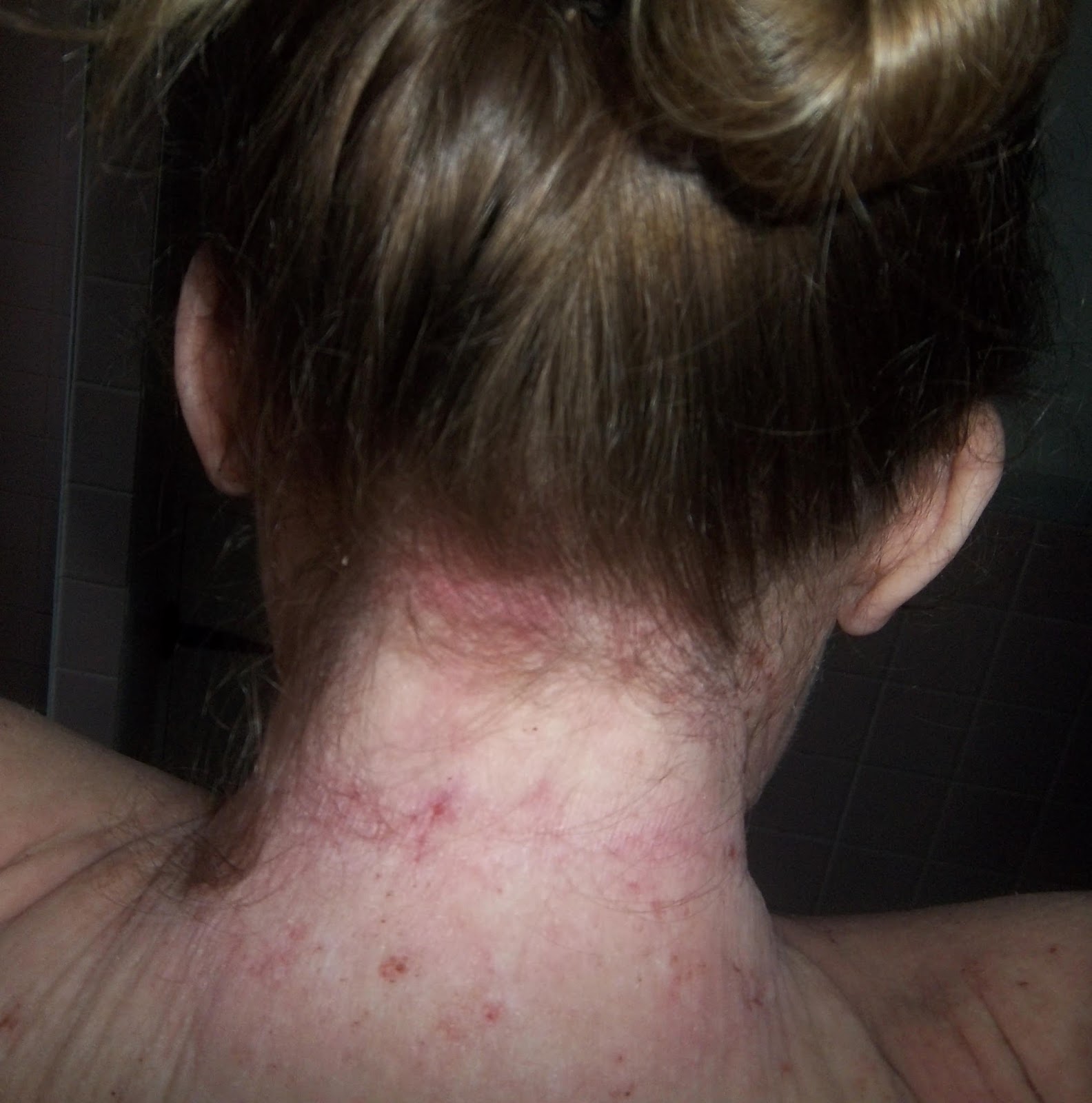 bumps on back hairline - MedHelp