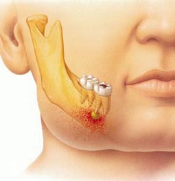 celulitis bucal en niños celulitis bucal en niños