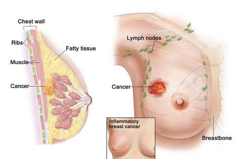 obat kanker payudara stadium 4, obat kanker payudara, pengobatan kanker payudara