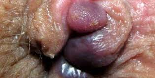 Foto Jual Obat Anti Wasir Antihemoroid Terbaru 2018