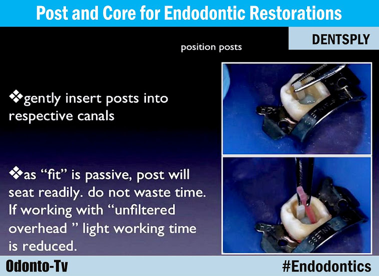 DENTSPLY Post and Core for Endodontic Restorations OdontoTv