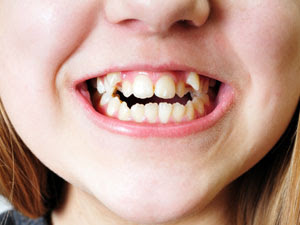 Có nên nhổ răng thừa không?