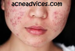 What is acne What causes acne