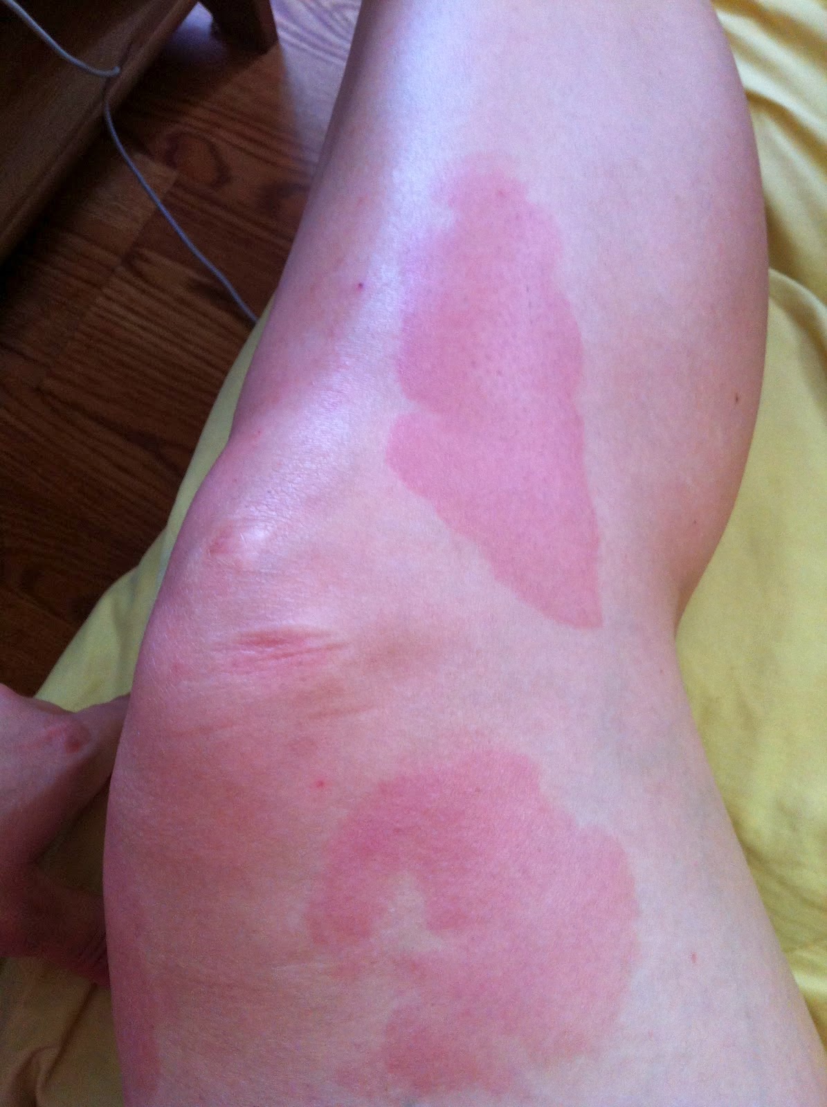 Ice is the Magic Medicine