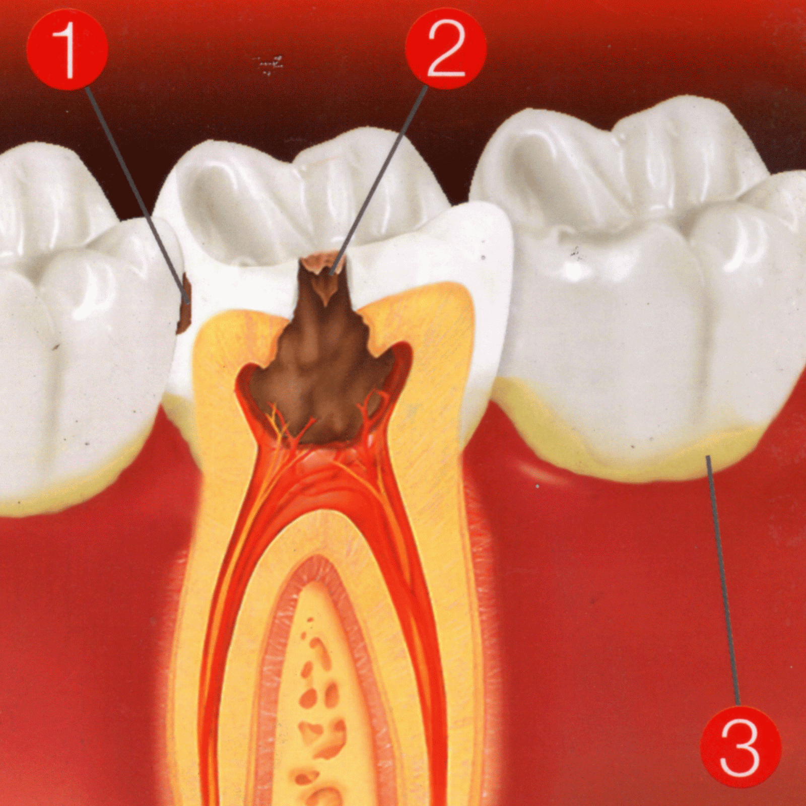 CENTRO ODONTOLOGICO BENAVIDES La Progresión de las Caries
