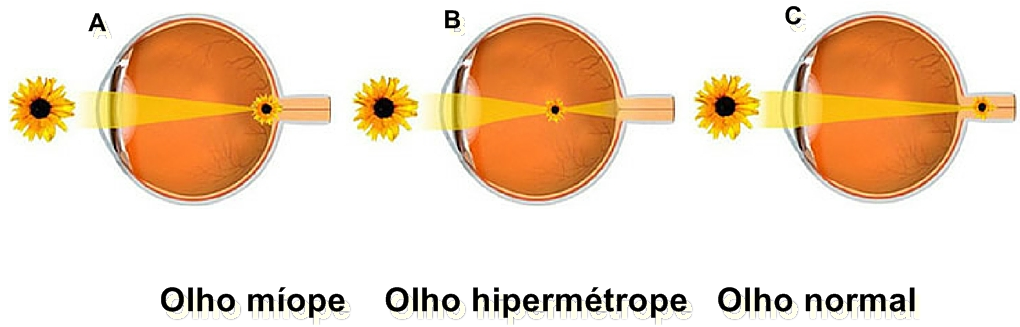 Ce este hipermetropia ?