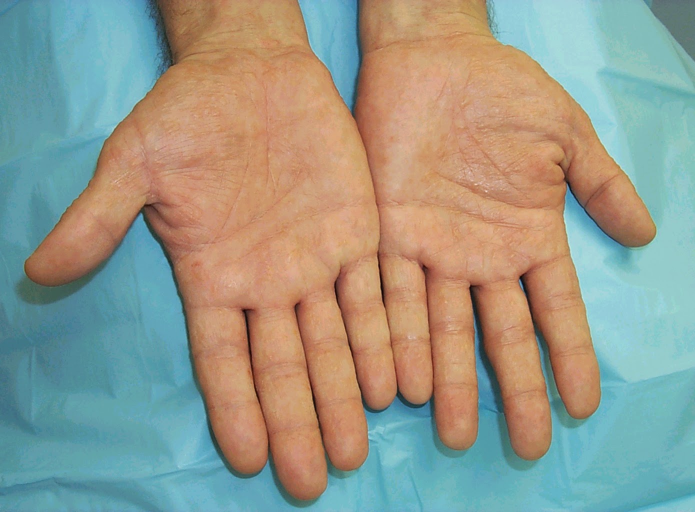 Skin Disease Types Vesicular Hand Dermatitis Skin Disease Type