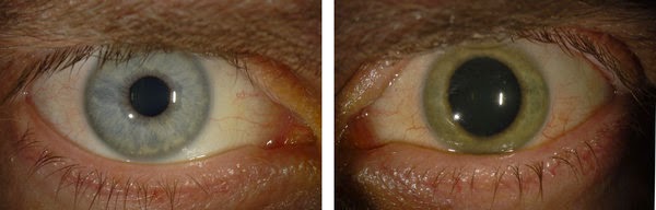 ebola eye pictures ebola eye pictures