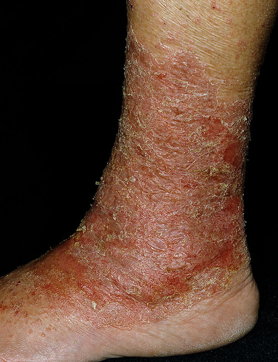 Dermatitis: Contact Dermatitis, Nummular Dermatitis ...