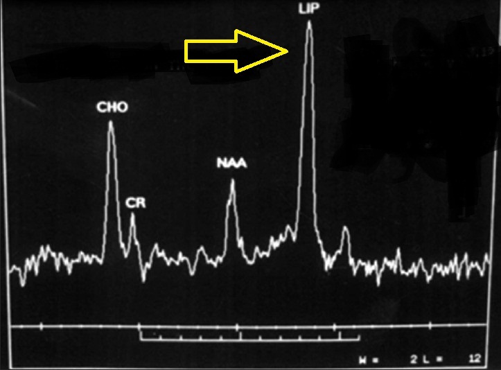 MR Spectroscopy and Tuberculoma Sumer's Radiology Blog