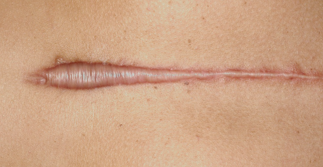 hipertrofik skar nedir keloid nedir