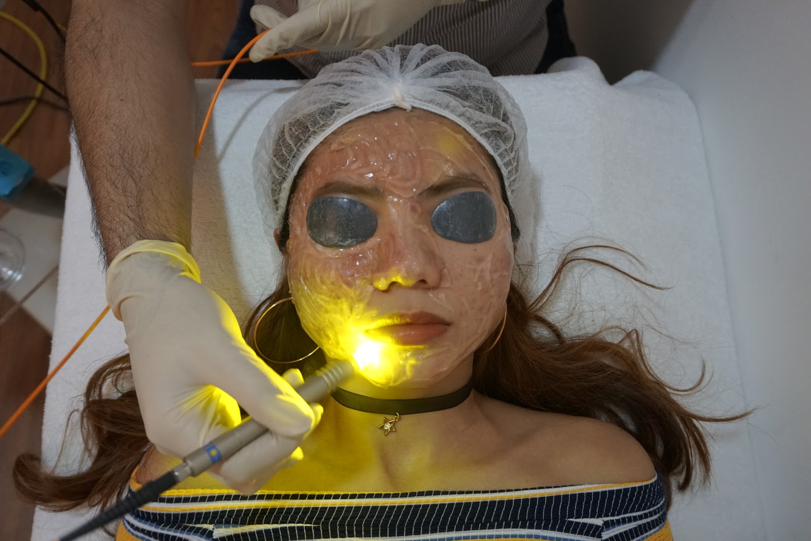 Laser for Acne Dual Yellow Laser Skin Gym SS2 J & D Learn to Blog