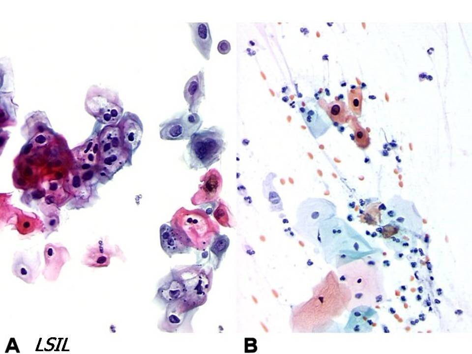 цитологическая картина lsil. жидкостная цитология по папаниколау. результат цитологического анализа – lsil. Lsil цитология форум. жидкостная цитология lsil.