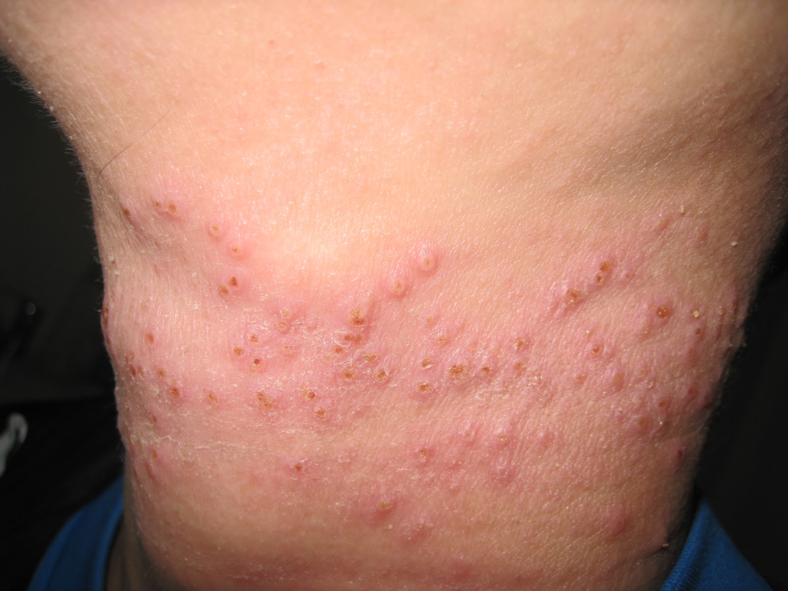 Eczema herpeticum - Huidarts.com