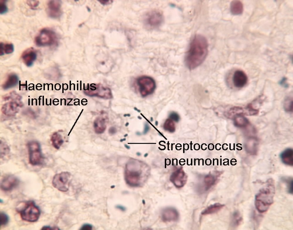 Haemophilus в мазке у мужчин. Гемофильная палочка микроскопия. Haemophilus influenzae (гемофильная палочка). Гемофилюс инфлюэнца в мазке.