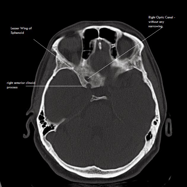 Greater Wing Of Sphenoid Radiograph