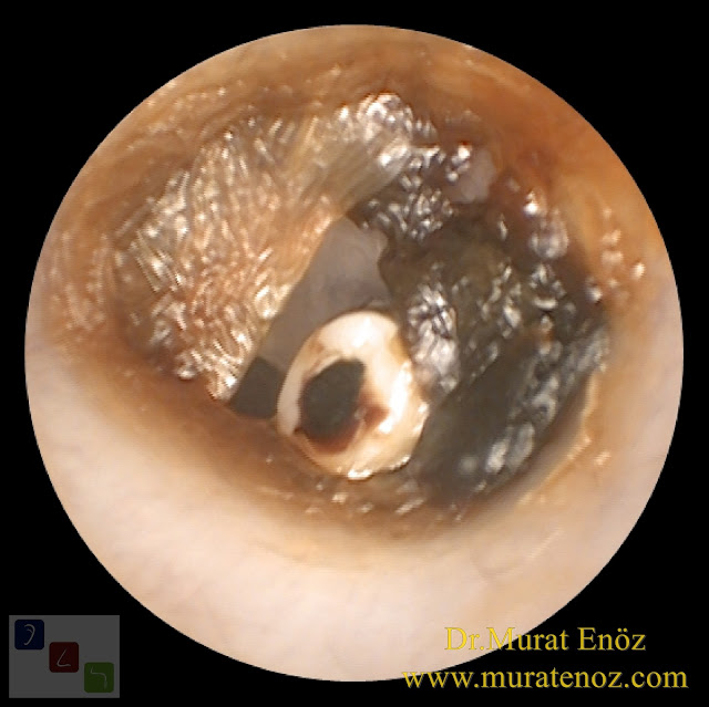 How does the ear tube fall out? - Some ear tubes can sponteously fall out? - What is an ear tube and what does it do? - Ensuring air transfer to the middle ear with ear tubes (ventilation) - When are ear tubes used? - How does the ear tube fall out? - If the ear tube fall out early ... - Symptoms of fall out early of ear ventilation tubes from eardrum - Does the ear tube cause pain as it falls? - What happens if the ear tube does not fall? - Damages of the ear tube - Ear tubes - Ear tube falls out - Ear tube removal - Ear ventilation tubes