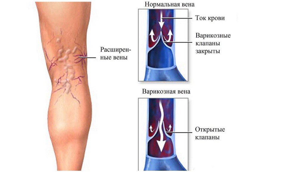 Варикозное Расширение Вен