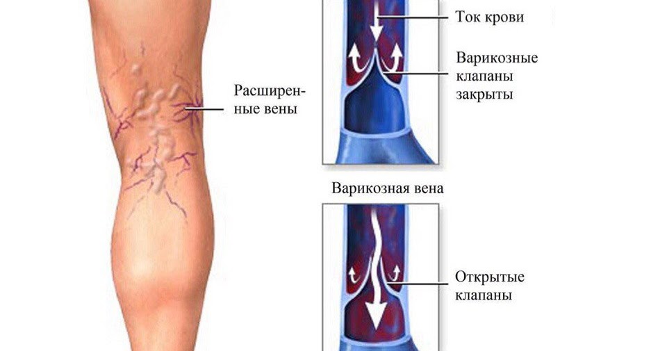 Может болеть нога от вен