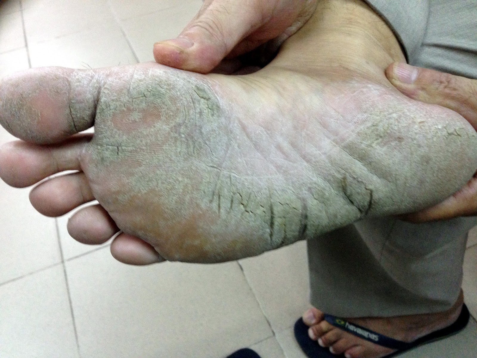 VIETNAMESE MEDIC ULTRASOUND CASE 385 PLANTAR, PALMAR VIETNAMESE MEDIC ULTRASOUND CASE 385 PLANTAR, PALMAR