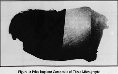 %name Científicos comienzan a analizar supuestos implantes extraterrestres