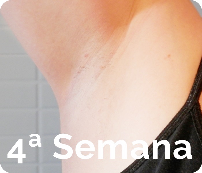 Depilacion IPL Philips Lumea antes después