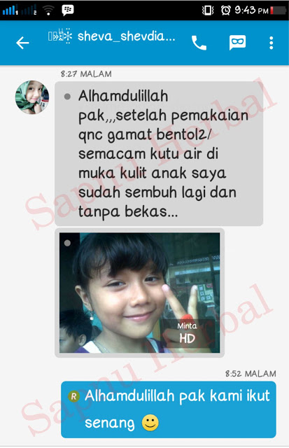 Cara Menghilangkan Keloid di Bibir Secara Alami dan Cepat Cara Menghilangkan Keloid di Bibir Secara Alami dan Cepat
