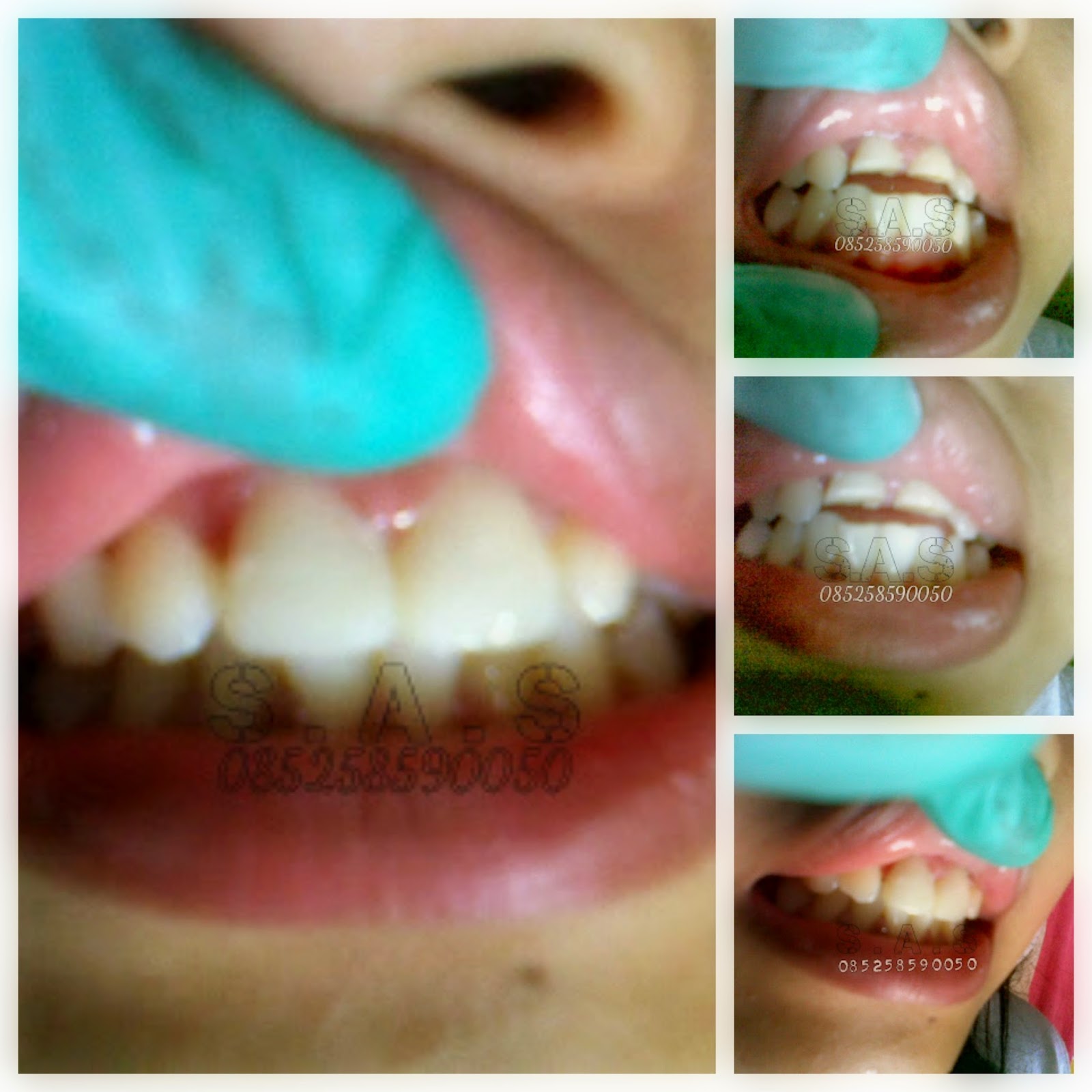 Foto Perbaikan Gigi Depan yang Patah Versi Ahli Gigi S.A.S Jateng | S.A