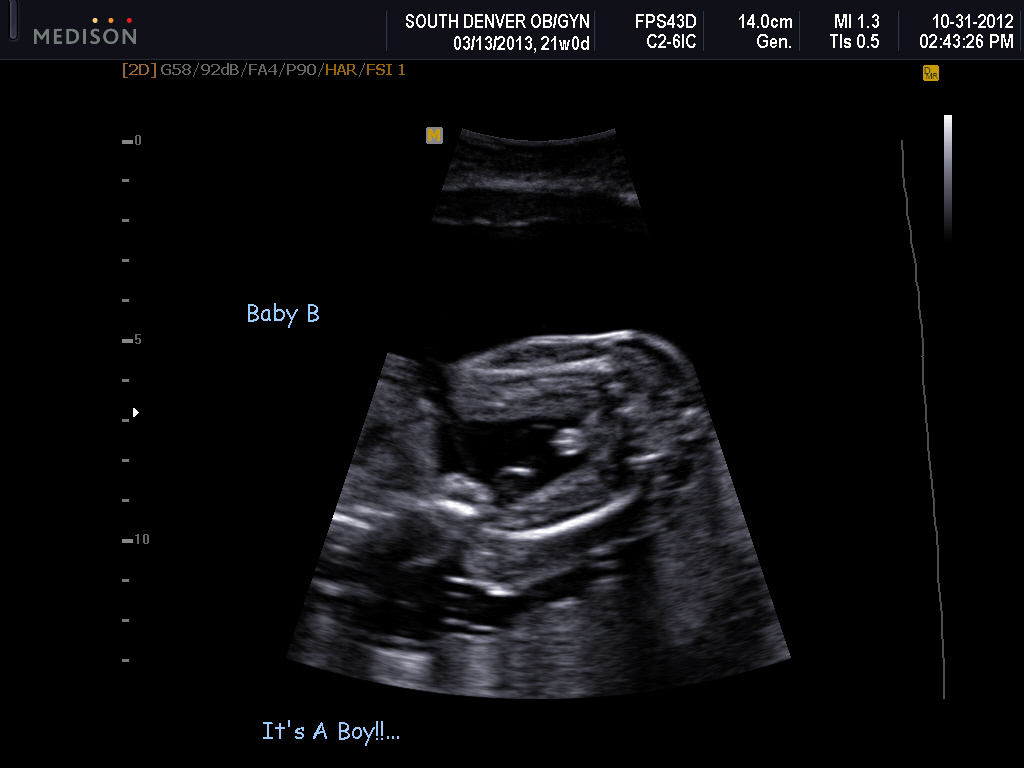 A Road Well Traveled: Anatomy Scan- 21 weeks!