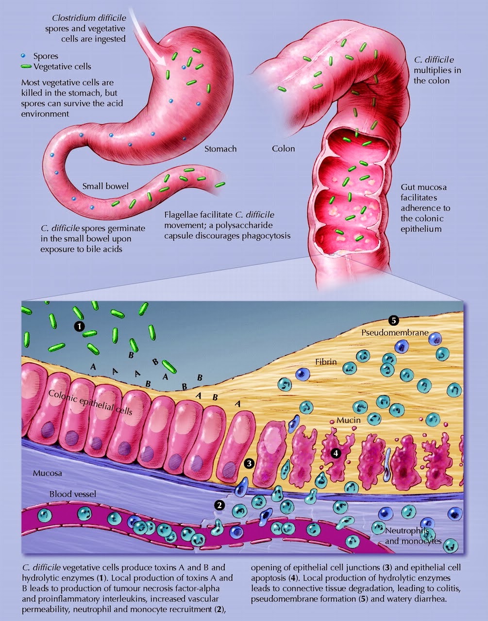 Doença de Crohn novas perspectivas Clostridium difficile